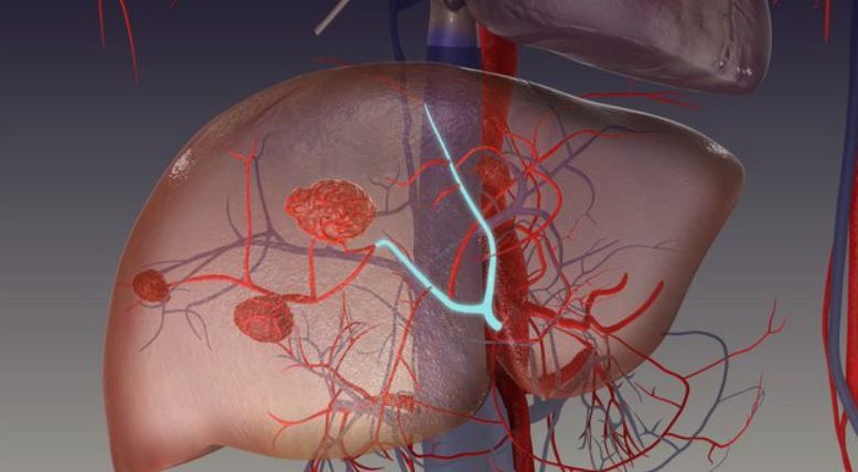 Chẩn đoán và điều trị u máu gan - bệnh viện Việt Đức
