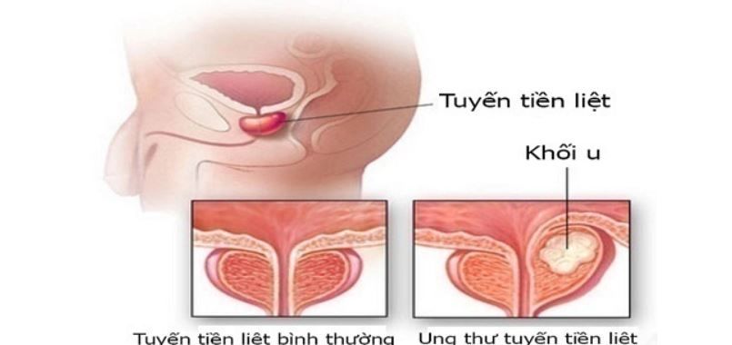Chẩn đoán và điều trị Ung thư tuyến tiền liệt - bệnh viện Việt Đức