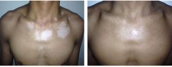 Các phương pháp điều trị bạch biến - bệnh viện da liễu trung ương