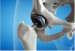 Cách chăm sóc bệnh nhân sau phẫu thuật thay khớp háng