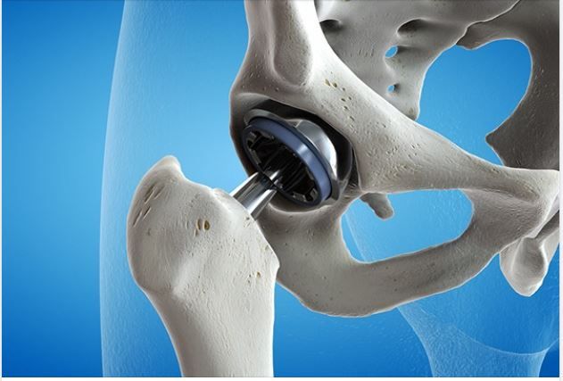 Cách chăm sóc bệnh nhân sau phẫu thuật thay khớp háng