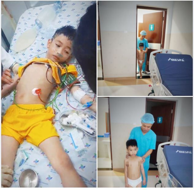 Tay chân miệng vẫn chuyển độ nặng nhất dù không có một nốt hồng ban!!