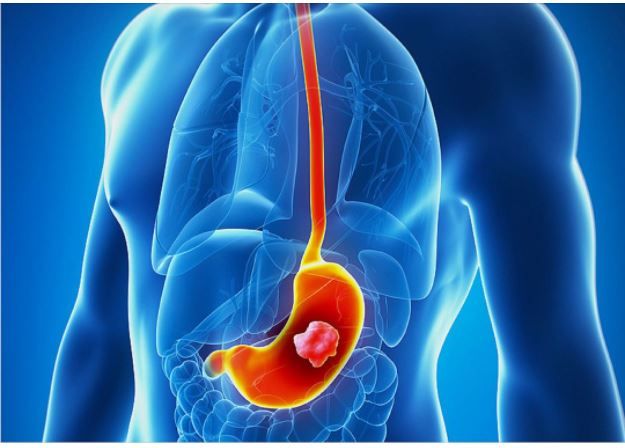 6 TRIỆU CHỨNG UNG THƯ DẠ DÀY TUYỆT ĐỐI KHÔNG ĐƯỢC BỎ QUA