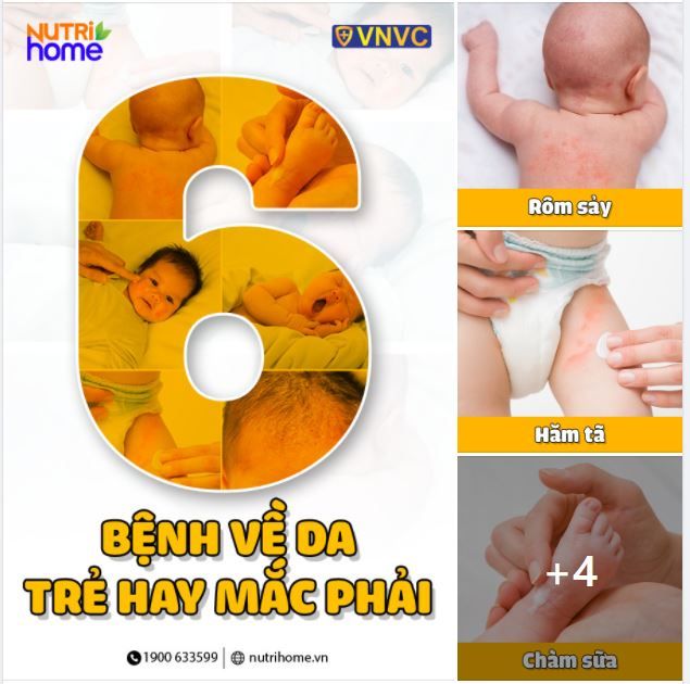 6 BỆNH VỀ DA THƯỜNG GẶP NHẤT KHI VÀO HÈ. TRỜI NẮNG NÓNG, MẸ NÊN CHĂM SÓC DA BÉ NHƯ THẾ NÀO?