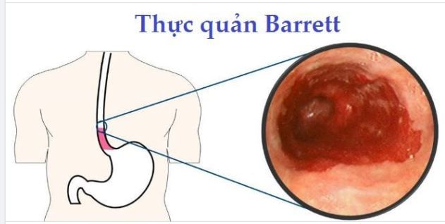 BARRET THỰC QUẢN TĂNG NGUY CƠ PHÁT TRIỂN UNG THƯ THỰC QUẢN