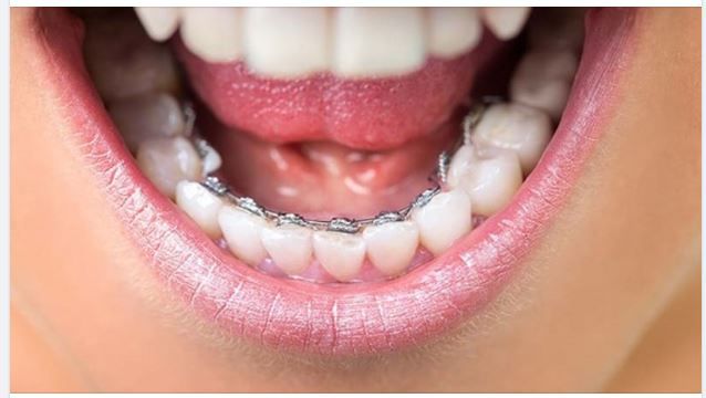 NIỀNG RĂNG MẶT TRONG LÀ PHƯƠNG PHÁP GÌ?
