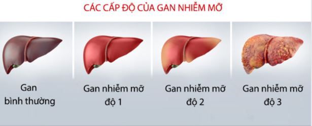 BIỂU HIỆN BỆNH LÝ GAN NHIỄM MỠ QUA TỪNG GIAI ĐOẠN