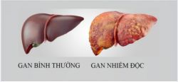 GIẬT MÌNH VỚI 6 DẤU HIỆU CẢNH BÁO GAN NHIỄM ĐỘC