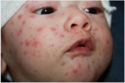 Triệu chứng trẻ sơ sinh bị bệnh thủy đậu ba mẹ nên lưu ý?