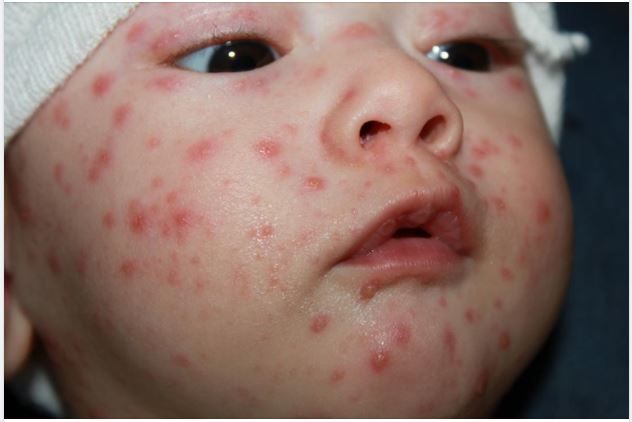 Triệu chứng trẻ sơ sinh bị bệnh thủy đậu ba mẹ nên lưu ý?
