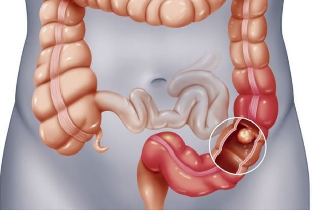 NỘI SOI DẠ DÀY ĐẠI TRÀNG “QUÉT SẠCH” MỌI POLYP