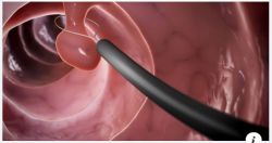 POLYP ĐẠI TRỰC TRÀNG, AI NÊN NỘI SOI ĐỂ PHÁT HIỆN SỚM??