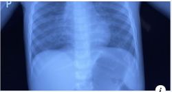 Cứu sống một trường hợp trẻ uống nhầm nước tẩy mực in