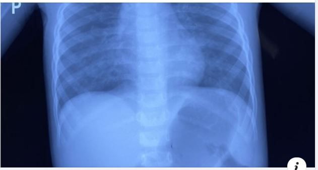 Cứu sống một trường hợp trẻ uống nhầm nước tẩy mực in