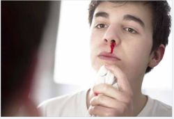 Chảy máu mũi là biểu hiện của bệnh gì?