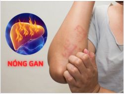 SỰ THẬT ĐÁNG SỢ VỀ NÓNG GAN - CÓ THỂ BẠN CHƯA BIẾT