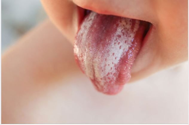 Trẻ sơ sinh bị trắng lưỡi có nguy hiểm không?