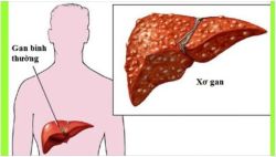BỆNH XƠ GAN - KHÓ CHỮA NHƯNG DỄ PHÒNG
