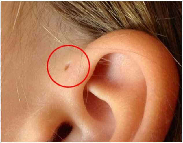 RÒ LUÂN NHĨ LÀ BỆNH GÌ? LÀM SAO ĐỂ ĐIỀU TRỊ BỆNH LÝ NÀY?