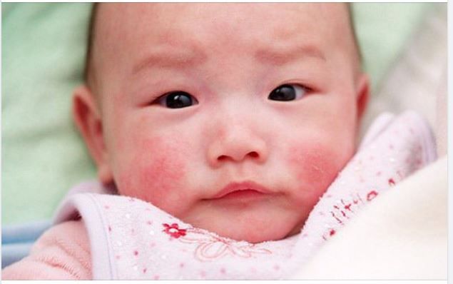 KHI TRẺ BỊ SỐC PHẢN VỆ, MẸ PHẢI XỬ LÝ THẾ NÀO?