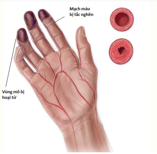 HÚT THUỐC LÁ LÀM TĂNG NGUY CƠ CẮT CỤT CHI Ở NGƯỜI MẮC BỆNH BUERGER