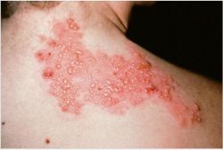 CẢNH GIÁC BIẾN CHỨNG NGUY HIỂM CỦA BỆNH ZONA THẦN KINH