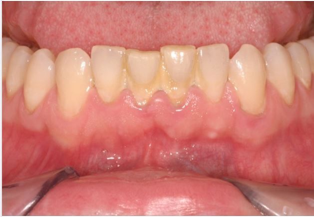 PHƯƠNG PHÁP HIỆU QUẢ ĐIỀU TRỊ CHÂN RĂNG BỊ VÀNG