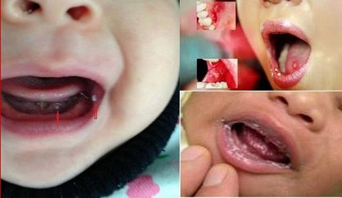 Nhận biết và điều trị nấm miệng - Bệnh viện Bạch Mai