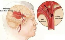 Đột quỵ não: Cần xử trí sớm và đúng cách - Bệnh viện Bạch Mai