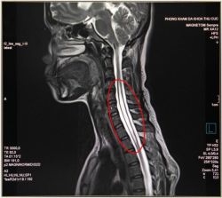 Rỗng tủy căn bệnh hiếm gặp 8,4/100 000 người mắc phải