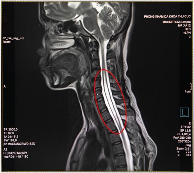 Rỗng tủy căn bệnh hiếm gặp 8,4/100 000 người mắc phải