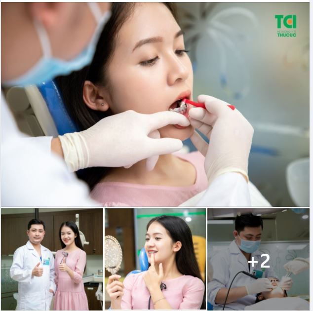 ĐỔI DIỆN MẠO NHỜ PHƯƠNG PHÁP NIỀNG RĂNG MẮC CÀI KIM LOẠI