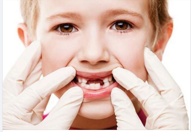 Phòng ngừa sâu răng hàm ở trẻ như thế nào?