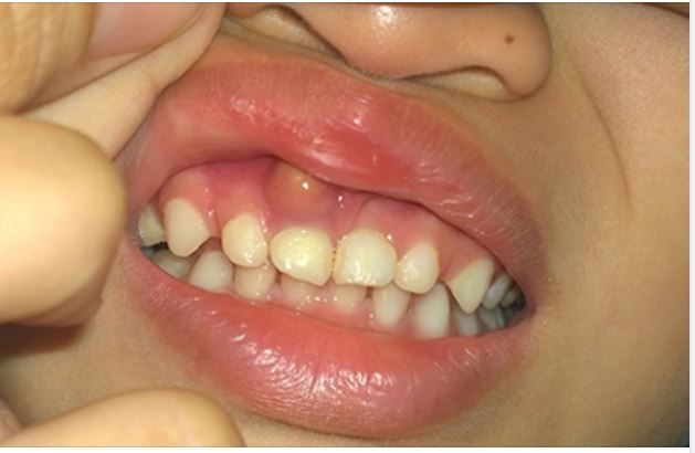 ĐIỀU TRỊ VIÊM NƯỚU RĂNG CÓ MỦ BẰNG CÁCH NÀO?
