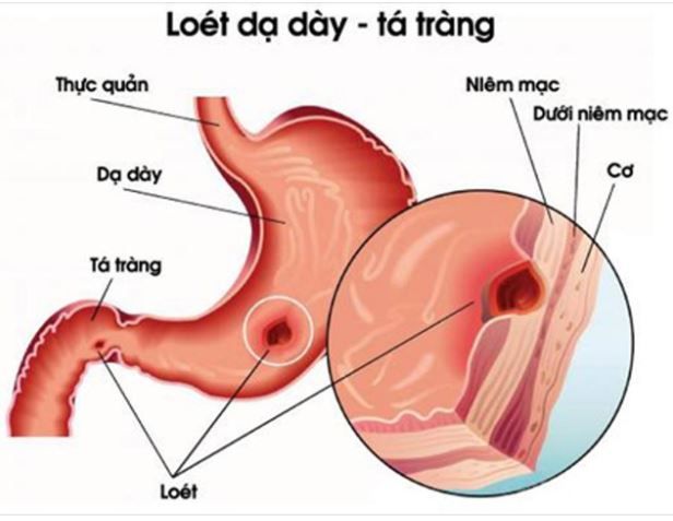 VIÊM LOÉT DẠ DÀY NGUY HIỂM NHƯ THẾ NÀO?