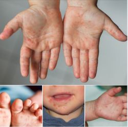 Tay chân miệng vào mùa, cha mẹ đã biết cách phòng bệnh cho con?