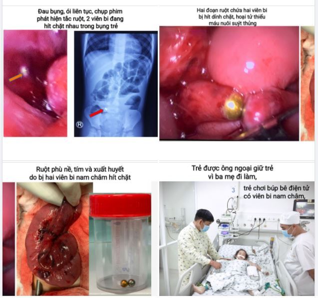 Muôn kiểu hóc dị vật ở trẻ - một phút lơ là của phụ huynh