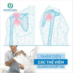 NHẬN DIỆN CÁC THỂ VIÊM QUANH KHỚP VAI