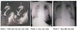 Một phụ nữ sốc phản vệ nguy kịch sau nhổ răng thoát chết hi hữu - Bệnh viện Bạch Mai