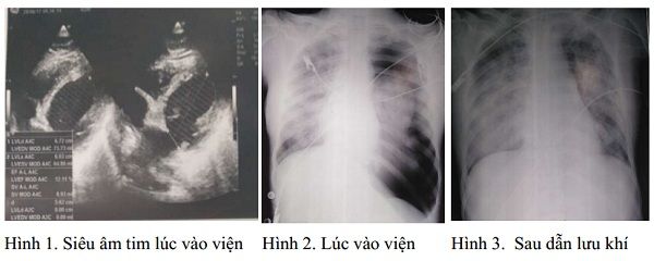 Một phụ nữ sốc phản vệ nguy kịch sau nhổ răng thoát chết hi hữu - Bệnh viện Bạch Mai