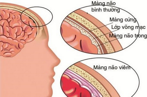 Nhận diện các chứng viêm màng não - viêm não dễ gặp - Bệnh viện Bạch Mai