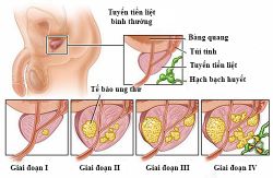 Các giai đoạn của bệnh ung thư tiền liệt tuyến - Bệnh viện Bạch Mai