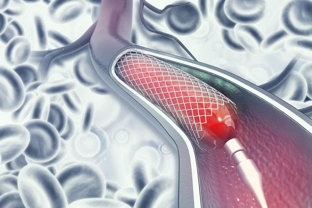 Sự khác nhau giữa nong mạch vành và đặt stent
