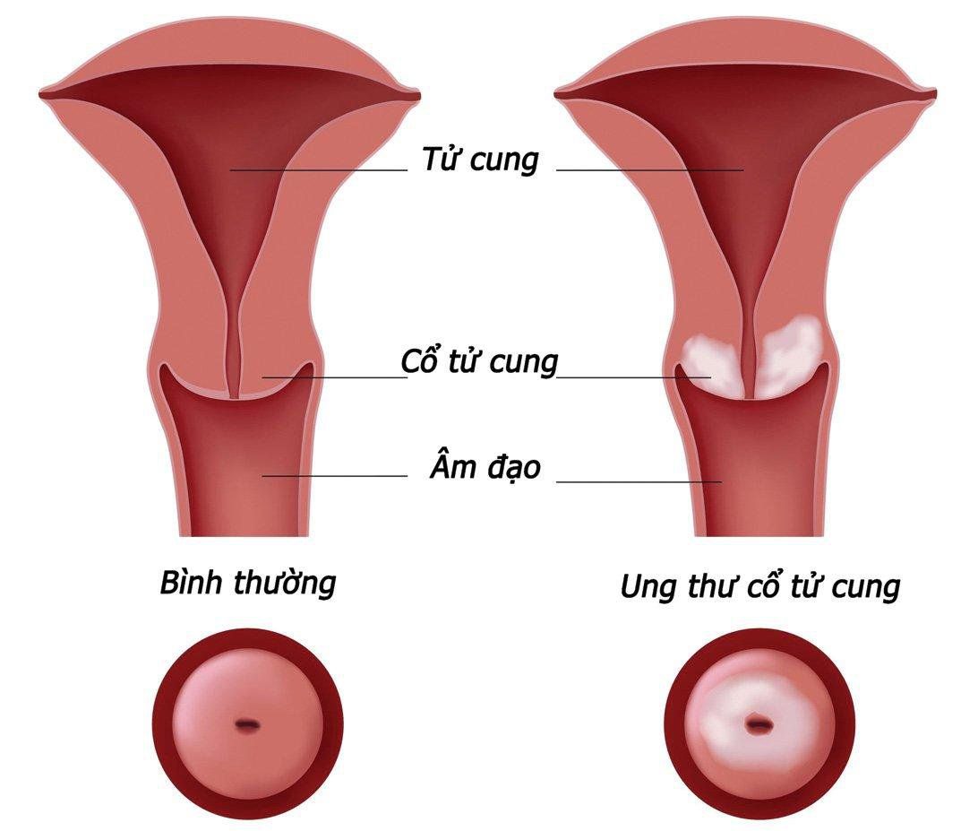 Những điều cần biết về vắc-xin HPV - Vắc-xin phòng ngừa ung thư cổ tử cung