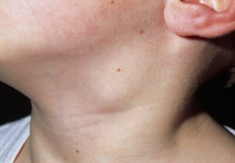 Sinh thiết hạch cổ: Khi nào cần làm?