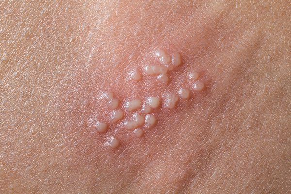 Các nguyên nhân gây viêm loét sinh dục