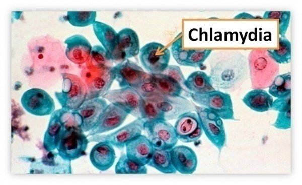 Cách nhận biết và điều trị bệnh viêm niệu đạo không do lậu