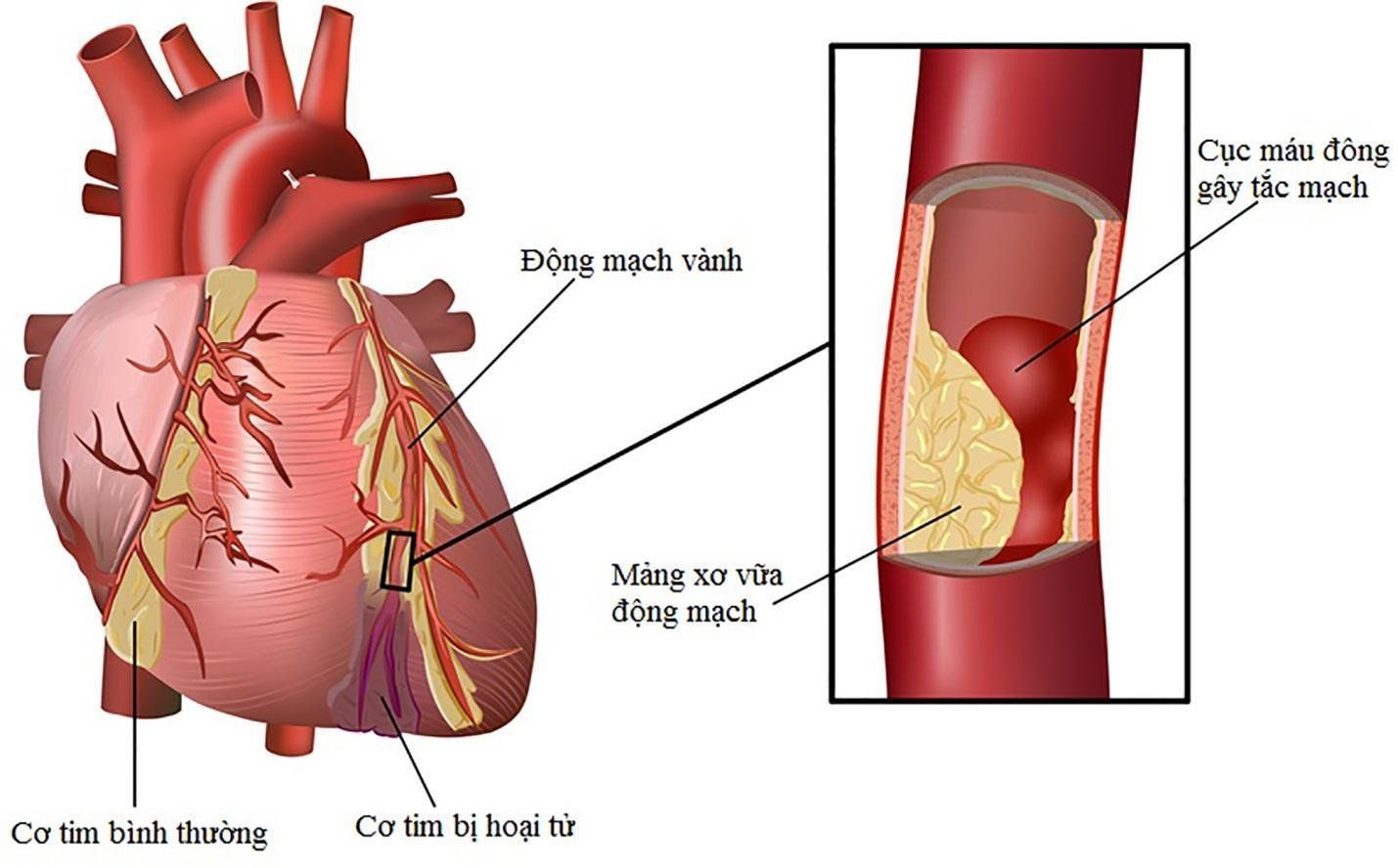 Nhồi máu cơ tim khác gì đột quỵ?