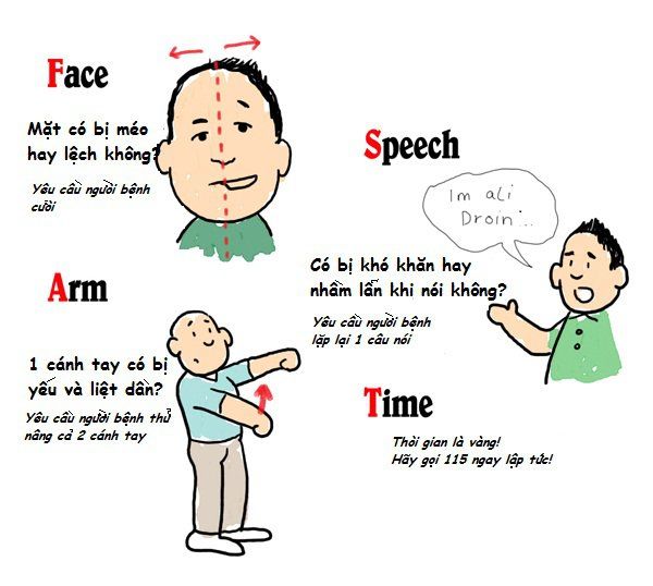 Chất hoạt hóa plasmogen mô trong đột quỵ nhồi máu não