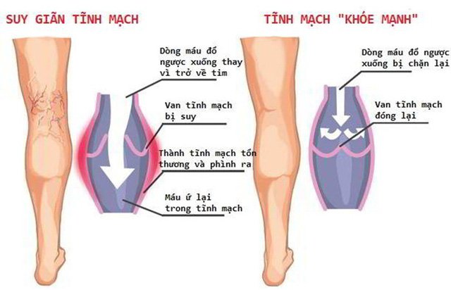 Điều trị suy giãn tĩnh mạch chi dưới bằng laser